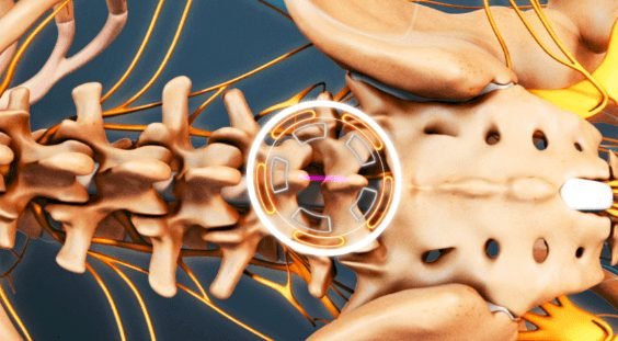 Most Recent Trial Court Verdicts For Spinal Discectomy In New York