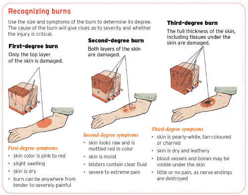 burn degrees