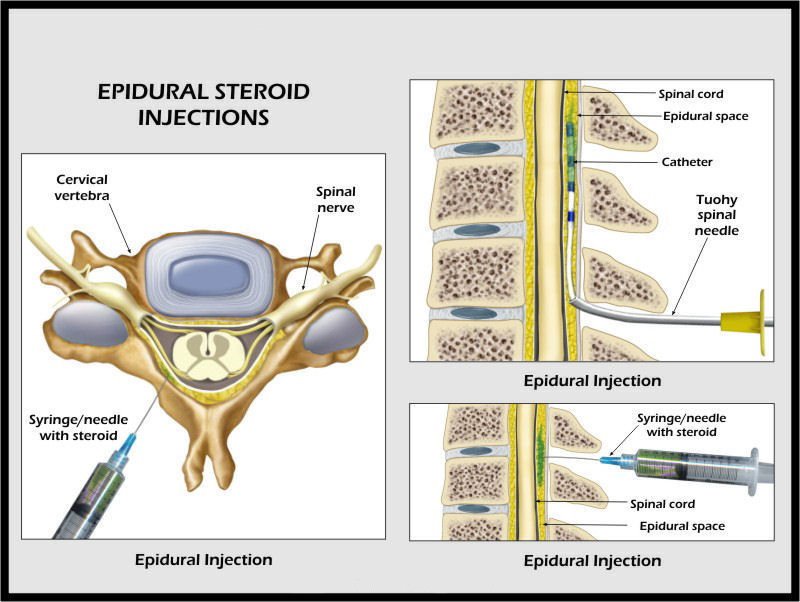 Epidural Spinal Injections Procedure