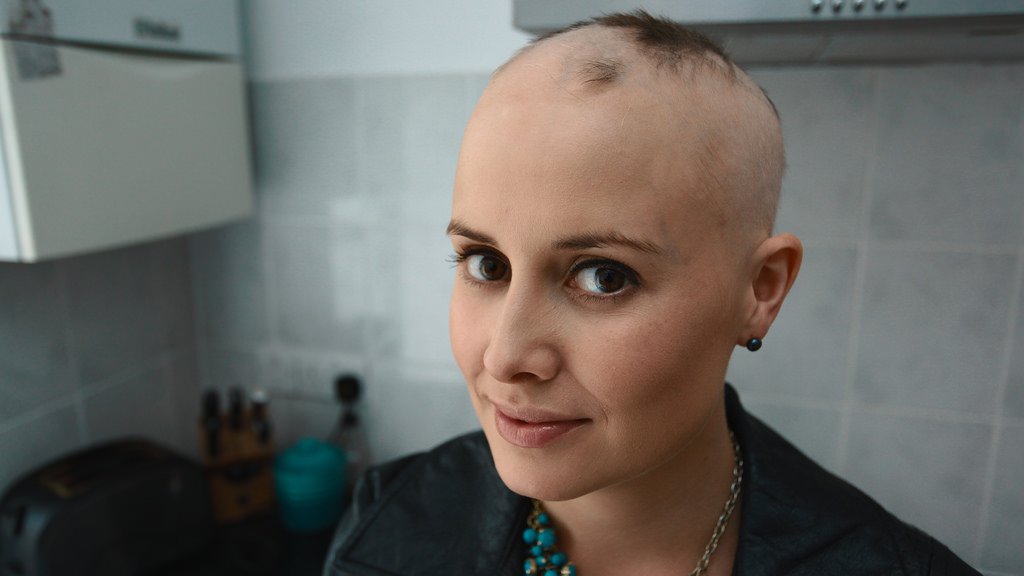 taxotere-hair-loss-breast-cancer-drug-causes-alopecia-in-women