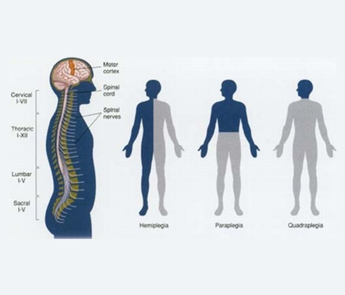 New York City Quadriplegia Lawyer