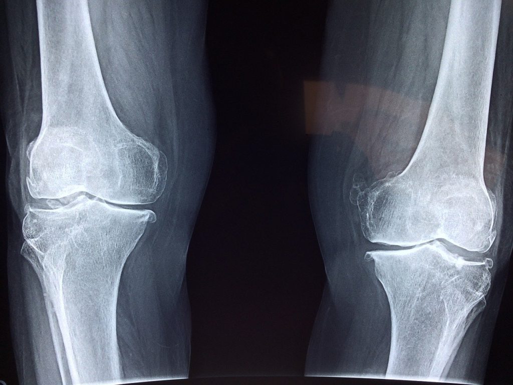 Average Arthroscopic Knee Surgery Settlement Values