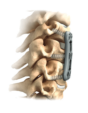 Arthrodesis 