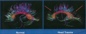 Diffusion Tensor Imaging