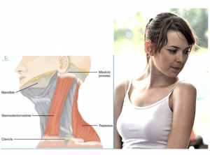 STERNOCLEIDOMASTOID