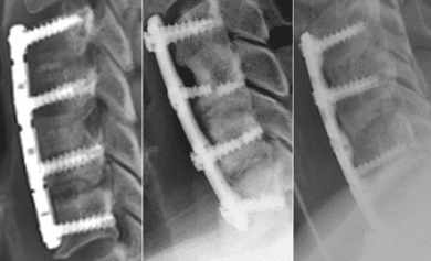 Intervertebral Implant