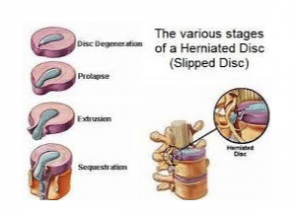 types of herniated discs