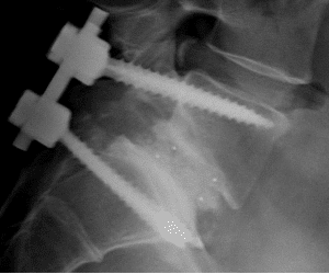 What Is a Spinal Fusion