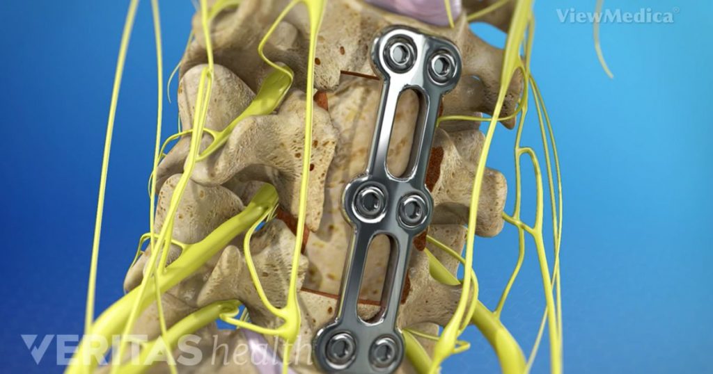 A corpectomy or vertebrectomy