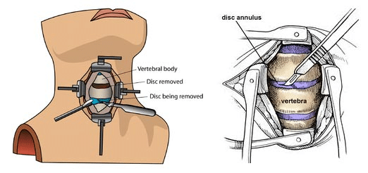 spinal cord surgery