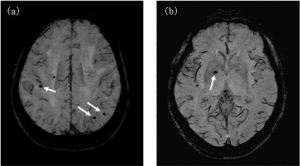 susceptibility weighted imaging