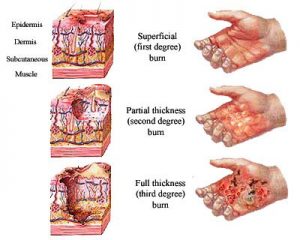 burn-injury-lawyers-new-york-city