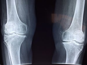 knee injury attorney