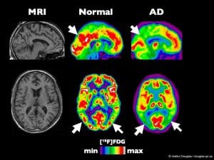 pet scan