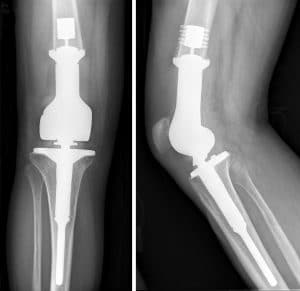 exactech-knee-lawsuit