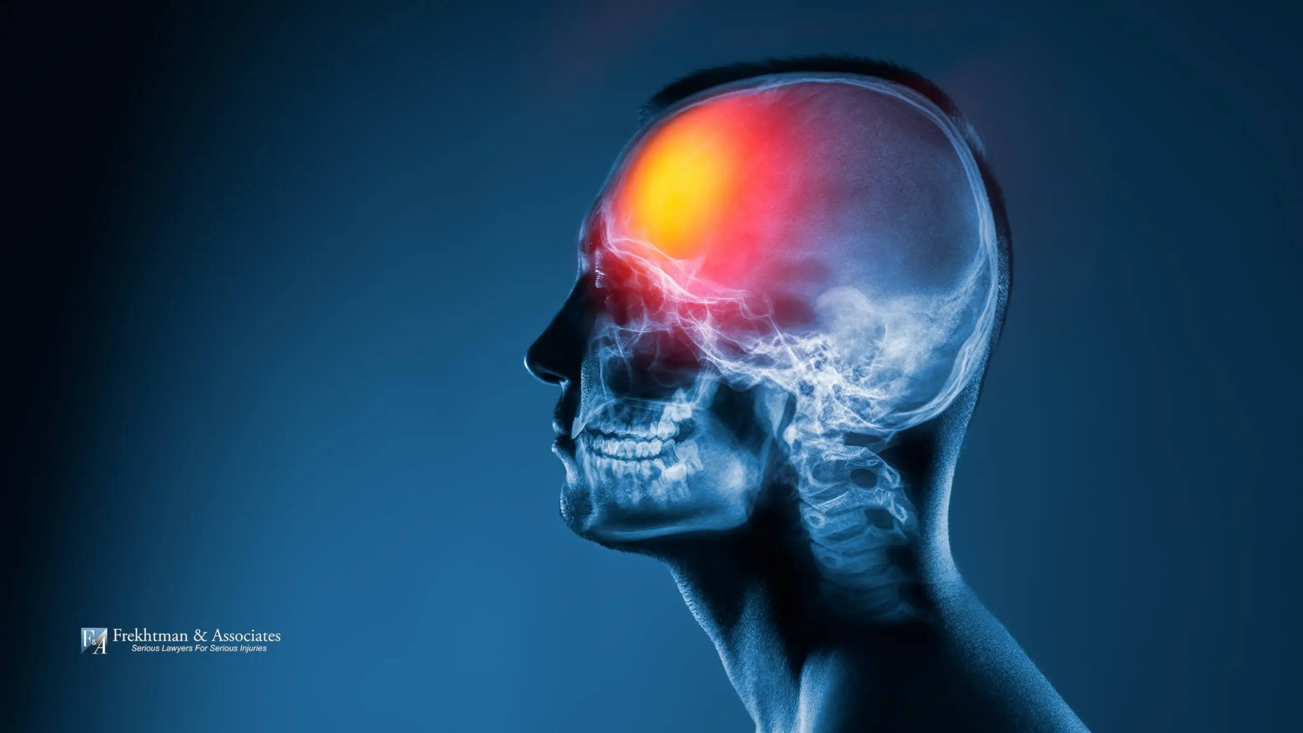 A medical illustration of a human skull in profile with a glowing red area on the frontal lobe indicating the point of impact and trauma from a brain injury.